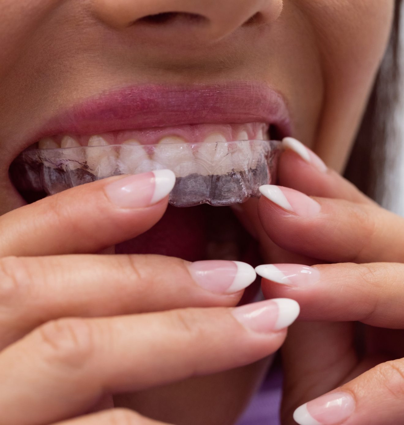 Protecting your teeth from grinding and clenching