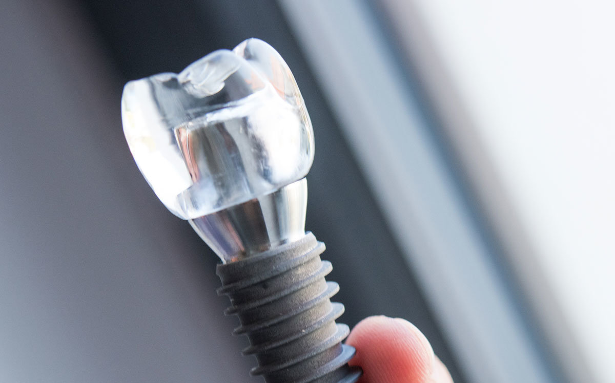 Zubní implantáty Onedent Brno Zubní implantáty Onedent Brno